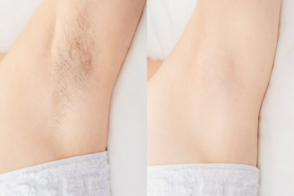 Waxing – An Ancient Technique That Is Popular For Unwanted Hair Removal