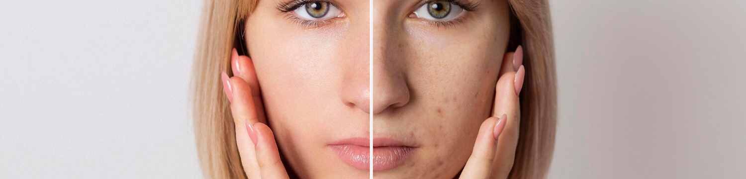 Collagen Facials Benefits for Skin Health