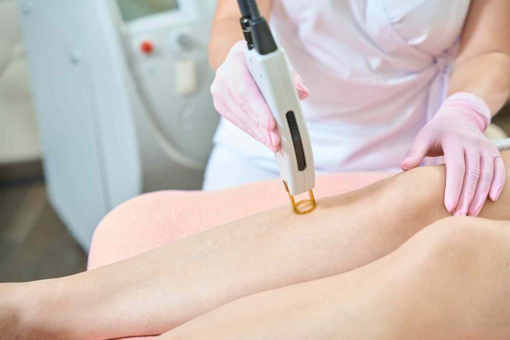 leg laser hair removal 