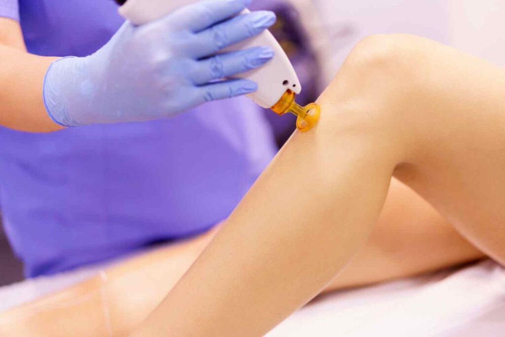 leg laser hair removal 